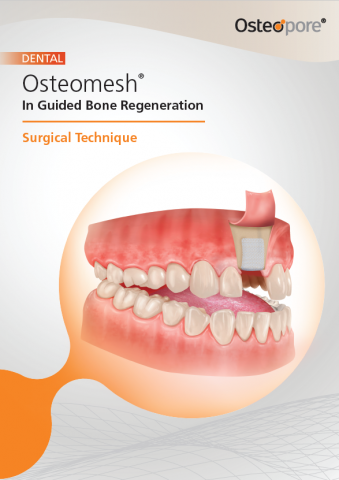 Guided Bone Regeneration Guide