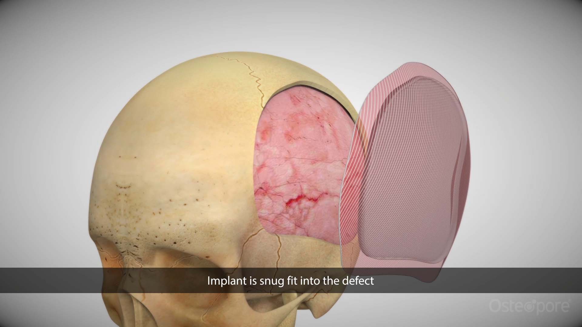 Cranioplasty PSI Feature Video