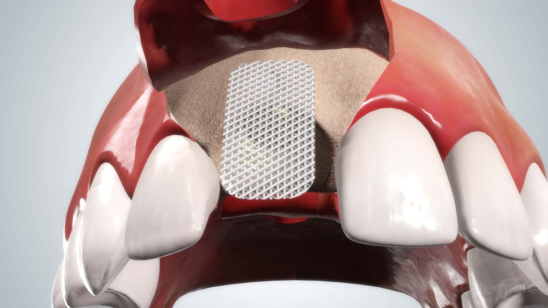 Feature Video - Immediate Implant Loading