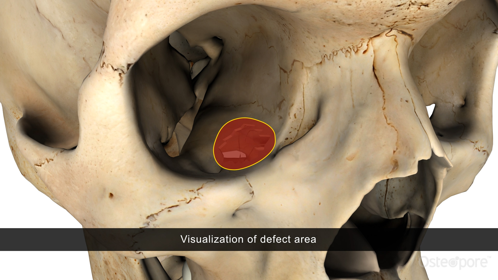Orbital Reconstruction Video